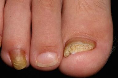 Micosis de unghii pe picioare
