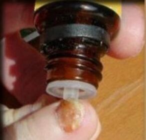 Aplicarea picăturilor pe unghia de la picior afectată de ciuperci